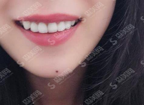 华西医院矫正牙齿费用,价格查询及牙齿矫正案例图片展示