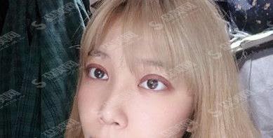 禾丽医美割双眼皮怎么样?果图一览+价格参考公布