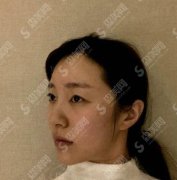 北京亚楠容悦眼部手术案例果图一览，2021较新眼部整形价格是多少钱？