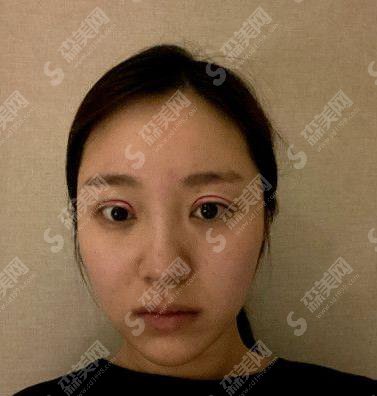 北京亚楠容悦眼部手术案例果图一览，2021较新眼部整形价格是多少钱？