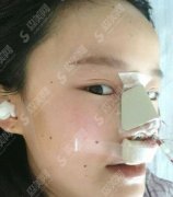 上海华美假体隆鼻一至七天照片，在分享假体隆鼻价格查询
