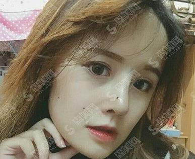 上海华美假体隆鼻一至七天照片,在分享假体隆鼻价格查询