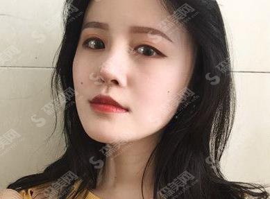 上海华美假体隆鼻一至七天照片,在分享假体隆鼻价格查询