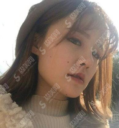 上海华美假体隆鼻一至七天照片,在分享假体隆鼻价格查询