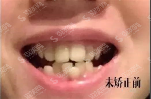 西京医院矫正牙齿大概多少钱?过程怎么样?果好吗?