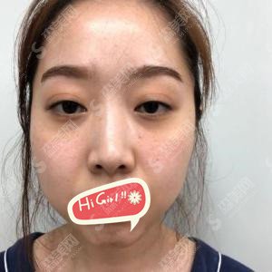 圣嘉荣价目表2021版一览分享,隆鼻果靠谱不？案例果展示图