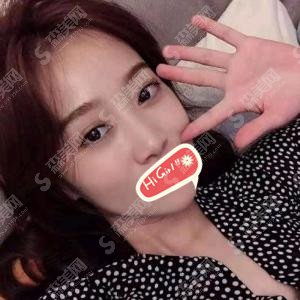 圣嘉荣价目表2021版一览分享,隆鼻果靠谱不？案例果展示图