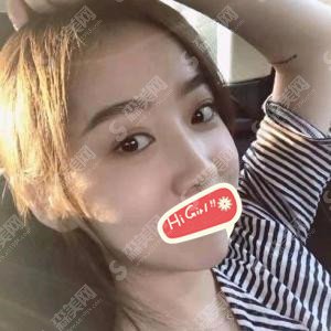 圣嘉荣价目表2021版一览分享,隆鼻果靠谱不？案例果展示图