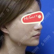 美容医院哪家好？西安华美怎么样？下颌角整形的果展示