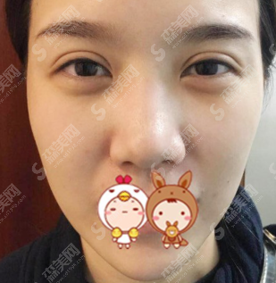 膨体隆鼻恢复期的图片对比赏析,隆鼻果展示和价目表分享！