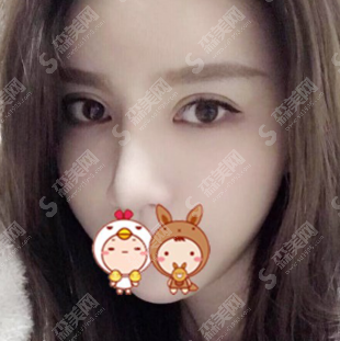 膨体隆鼻恢复期的图片对比赏析,隆鼻果展示和价目表分享！