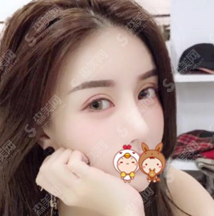 膨体隆鼻恢复期的图片对比赏析,隆鼻果展示和价目表分享！