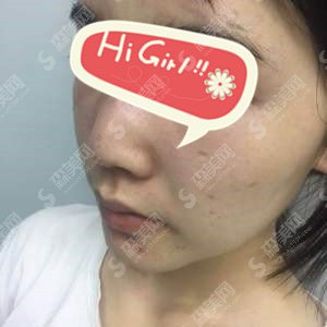 合肥美容医院怎么样？合肥壹加壹垫下巴案例的对比分享,轮廓改变以后的我整的美极了！
