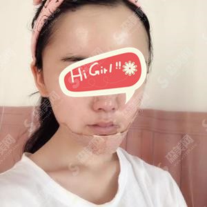 合肥美容医院怎么样？合肥壹加壹垫下巴案例的对比分享,轮廓改变以后的我整的美极了！