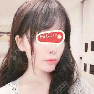 合肥美容医院怎么样？合肥壹加壹垫下巴案例的对比分享,轮廓改变以后的我整的美极了！