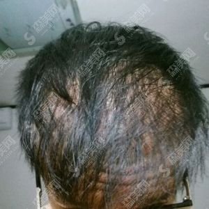 沧州中西医结合医院植发的恢复果图展示！内含新的整形价目表欣赏