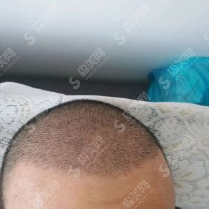 沧州中西医结合医院植发的恢复果图展示！内含新的整形价目表欣赏