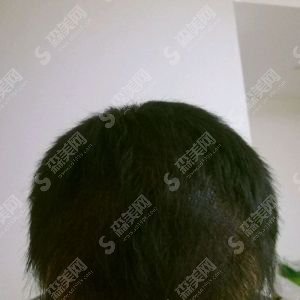 沧州中西医结合医院植发的恢复果图展示！内含新的整形价目表欣赏