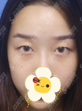 沧州华美整形医院正规吗？眼部整形的果及较新的整形价目表分享！