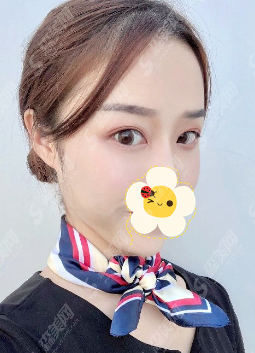 沧州华美整形医院正规吗？眼部整形的果及较新的整形价目表分享！