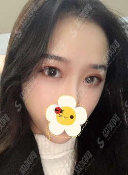 沧州华美整形医院正规吗？眼部整形的果及较新的整形价目表分享！