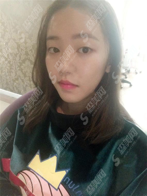 北京哪个医院割双眼皮好?如何选择医院?双眼皮术后果好吗?