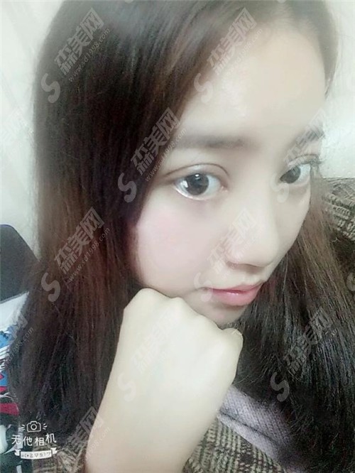 北京哪个医院割双眼皮好?如何选择医院?双眼皮术后果好吗?