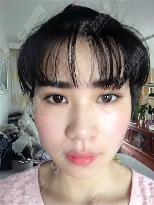 合肥曙光植发医院植发靠谱吗?植发复杂吗?术后要注意什么?