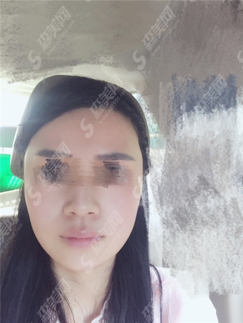 合肥曙光植发医院植发靠谱吗?植发复杂吗?术后要注意什么?