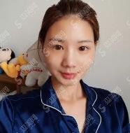 北京八大处面部脂肪填充的果好吗？案例分享及价格收费不要错过！