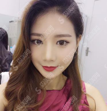 北京八大处面部脂肪填充的果好吗？案例分享及价格收费不要错过！