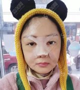上海九院蒋朝华做鼻子怎么样？分享下隆鼻的整个过程及术后果图