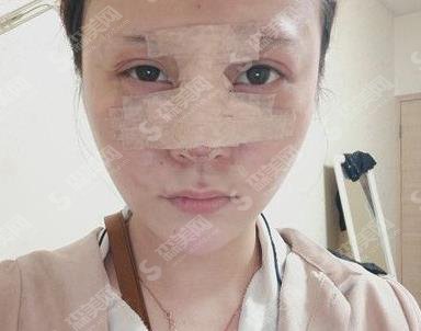 上海美联臣肋软骨隆鼻价格一览表,在分享整形案例果浏览