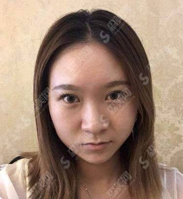 沈阳隆鼻好的三甲医院有哪些?盛京医院隆鼻案例及价格表公布