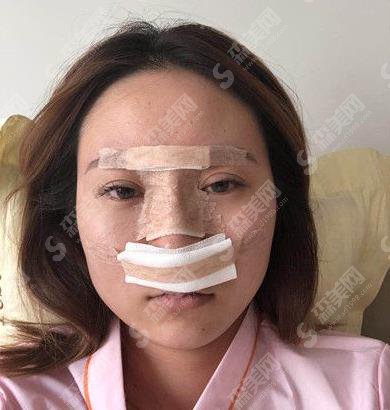 沈阳隆鼻好的三甲医院有哪些?盛京医院隆鼻案例及价格表公布