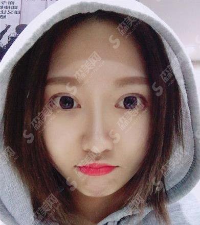 沈阳隆鼻好的三甲医院有哪些?盛京医院隆鼻案例及价格表公布