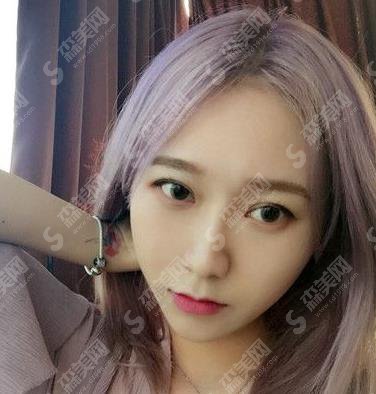 沈阳隆鼻好的三甲医院有哪些?盛京医院隆鼻案例及价格表公布