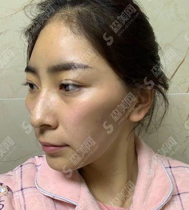 深圳北大脂肪填充哪个医生好？胡华新填充技术可以吗？专家简介及案例展示