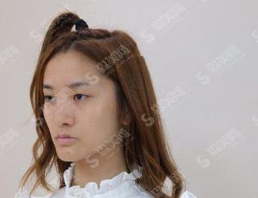 辽宁协和整形医院靠谱吗?眼部手术案例反馈+眼部整形价格收费标准