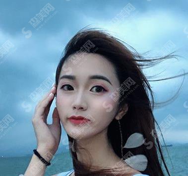 辽宁协和整形医院靠谱吗?眼部手术案例反馈+眼部整形价格收费标准