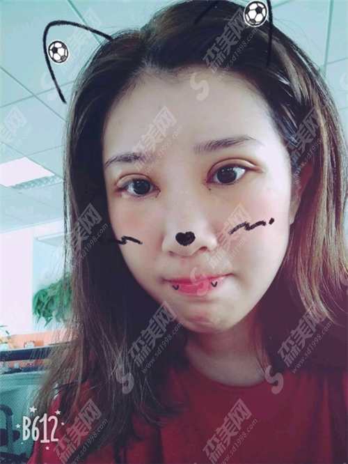 张小红整形医院价格表呈现,张小红整形医院怎么样?真实整形案例分享