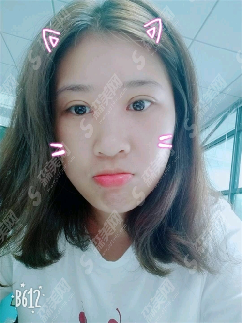 张小红整形医院价格表呈现,张小红整形医院怎么样?真实整形案例分享