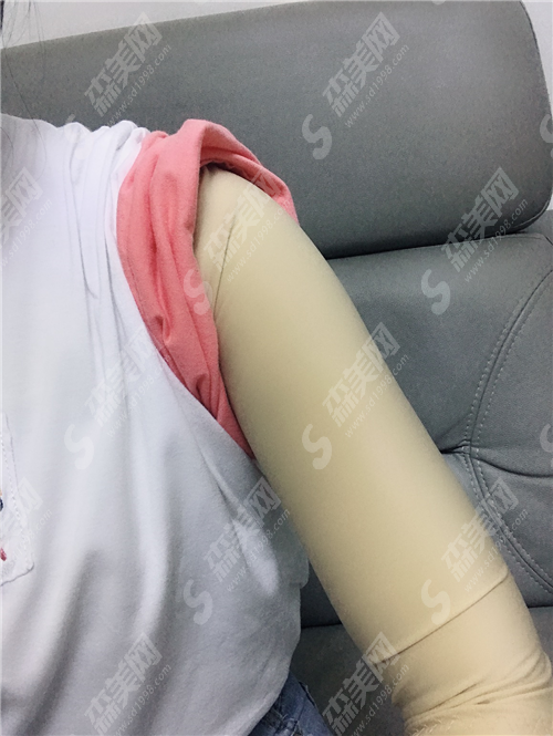 手臂环吸多少钱?环吸与抽脂的区别在哪里?成功手臂环吸案例分享