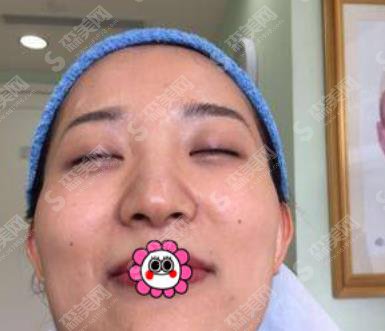 北京做双眼皮修复的医生哪个好?谭章梅眼部整形案例分享及价格表参考
