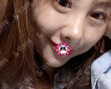 北京做双眼皮修复的医生哪个好?谭章梅眼部整形案例分享及价格表参考