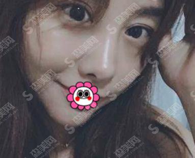 北京做双眼皮修复的医生哪个好?谭章梅眼部整形案例分享及价格表参考