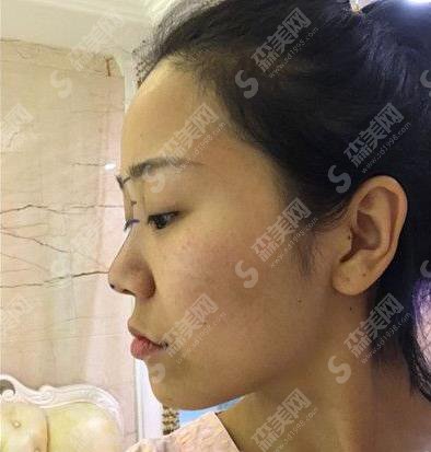 魏紫林医生隆鼻果好吗?专家个人简介/价格参考/案例参考