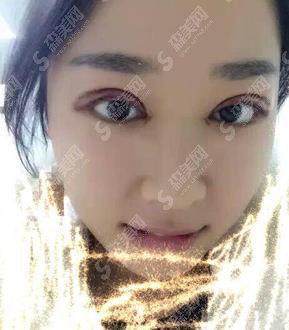 胡忠民做的双眼皮好吗？2021眼部整形价格及术后恢复欣赏