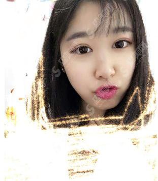 胡忠民做的双眼皮好吗？2021眼部整形价格及术后恢复欣赏