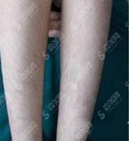 北京长虹激光脱毛价目表2021,激光脱毛后拥有了自信,完成了多年夙愿!